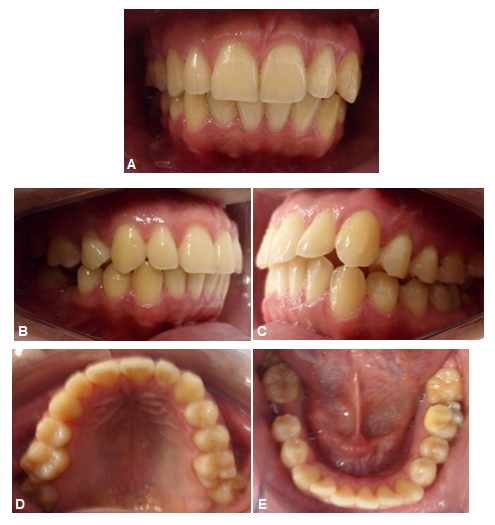 Afinal, como o invisalign corrige a posição dos dentes? - SNG Odontologia