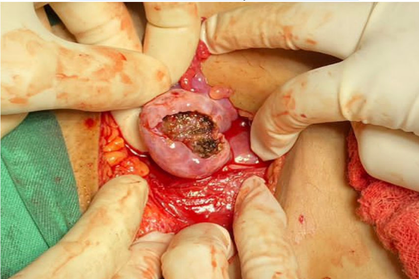 Retirada do Ovário > Cirurgia e Recuperação da Ooforoplastia