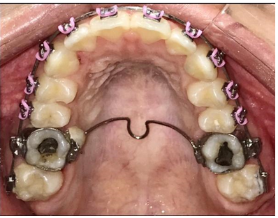 PDF ) Estudo das alterações dento-esqueléticas decorrentes do tratamento da  má oclusão de classe II, 1ª divisão, com o aparelho propulsor mandibular  twin force bite corrector, associado à aparelhagem fixa