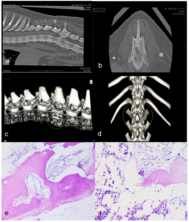 Hereditary multiple exostoses with spinal cord compression.