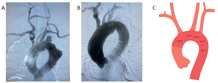 Modelo anatômico de aneurisma da aorta abdominal - 021 series