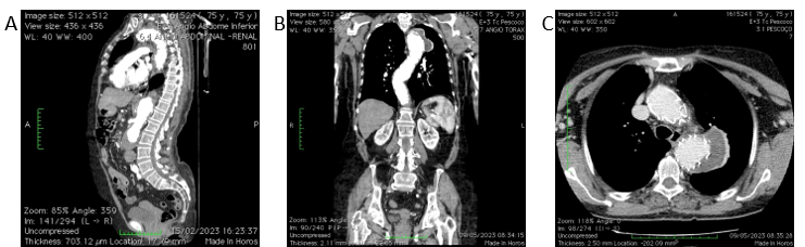 Modelo anatômico de aneurisma da aorta abdominal - 021 series