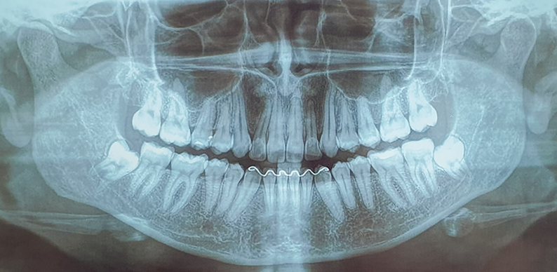 Radiografia Panorâmica de Mandíbu-la. Pós-Operatório de cinco meses.