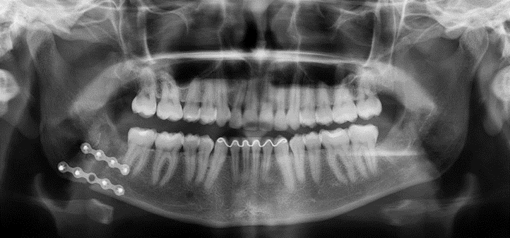 Radiografia Panorâmica de Mandíbu-la. Pós-Operatório de cinco meses.